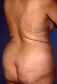 Before Image: Liposuction - right-back-oblique