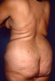 Before Image: Liposuction - left-back-oblique