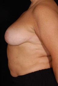 Breast Reduction