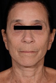 Brow Lift