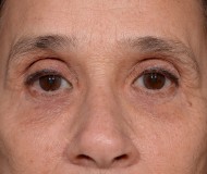 Blepharoplasty