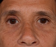 Blepharoplasty