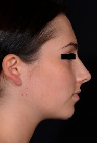 Rhinoplasty