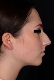 Rhinoplasty