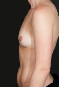 Breast Augmentation