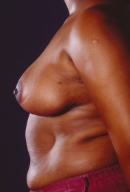 Breast Reduction