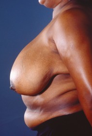 Breast Reduction