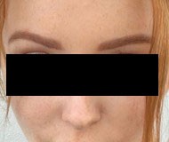 Brow Lift