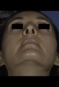 Rhinoplasty