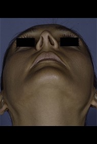 Rhinoplasty