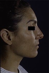 Rhinoplasty