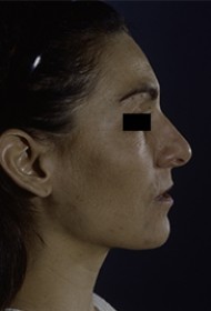 Rhinoplasty