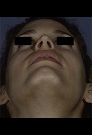 Rhinoplasty