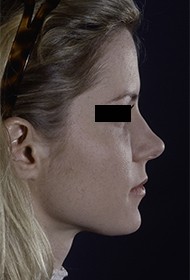 Rhinoplasty