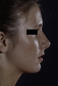 Rhinoplasty