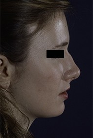 Rhinoplasty