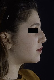 Rhinoplasty