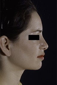 Rhinoplasty