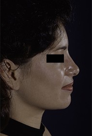 Rhinoplasty