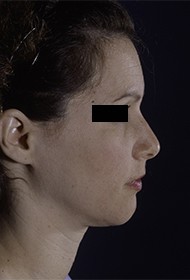 Rhinoplasty