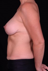 Breast Uplift – Augmentation