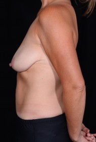 Breast Uplift – Augmentation