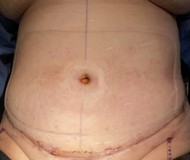 Abdominoplasty