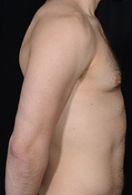 Male Breast Reduction (Gynecomastia)