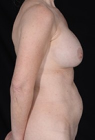 Abdominoplasty