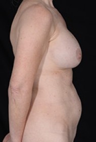 Liposuction