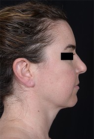 Rhinoplasty