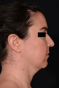 Rhinoplasty