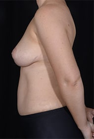 Liposuction