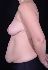 Liposuction