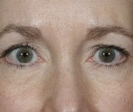 Blepharoplasty