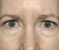 Blepharoplasty