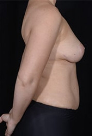 Abdominoplasty