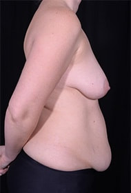 Abdominoplasty