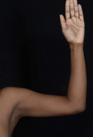 After Image: Liposuction - front