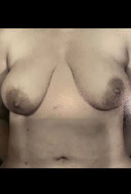 Breast Lift