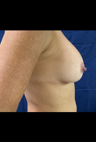 Breast Revision