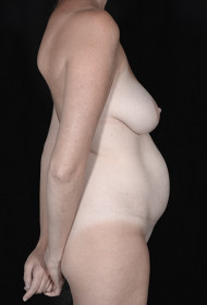 Liposuction