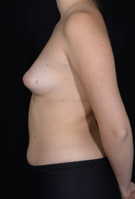 Breast Augmentation