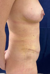 Abdominoplasty