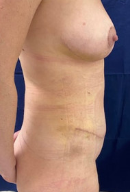 Liposuction