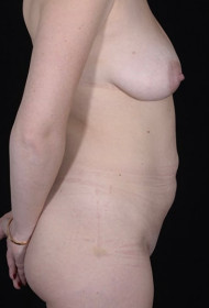 Liposuction