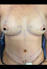 Breast Augmentation