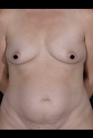 Breast Augmentation