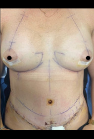 Abdominoplasty