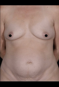 Abdominoplasty